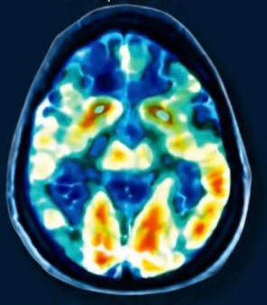 After treatment - non-depressed brain scan