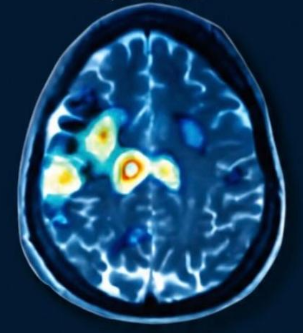 Before treatment - depressed brain scan